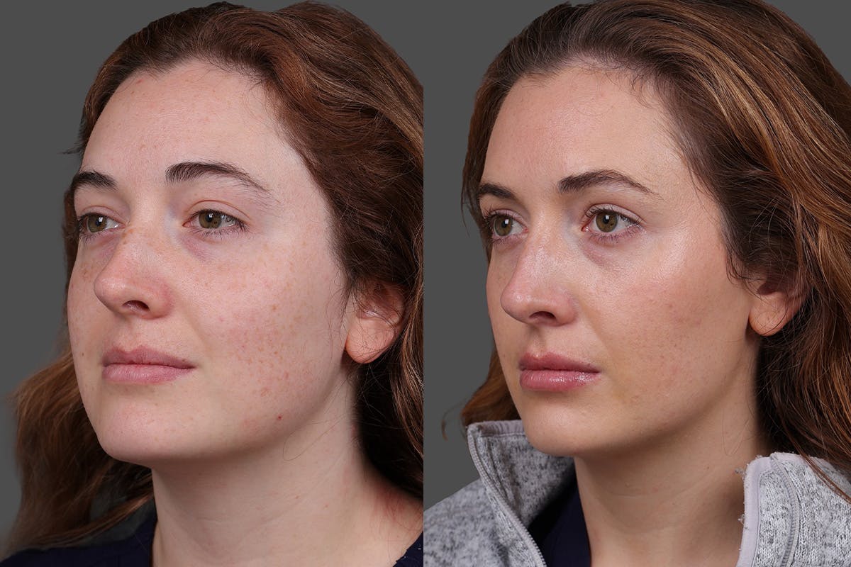 Restylane Before & After Gallery - Patient 750885 - Image 4