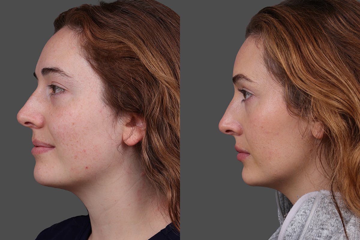 Restylane Before & After Gallery - Patient 750885 - Image 5