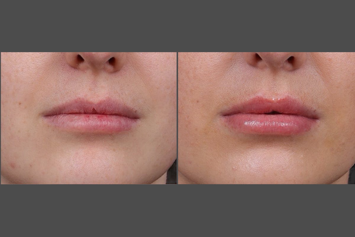Restylane Before & After Gallery - Patient 750885 - Image 6