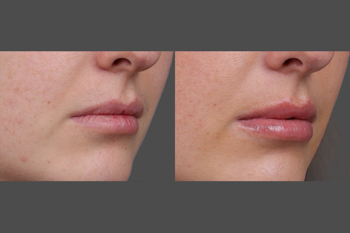 Restylane Before & After Gallery - Patient 750885 - Image 7