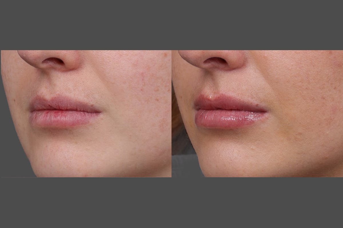 Restylane Before & After Gallery - Patient 750885 - Image 8
