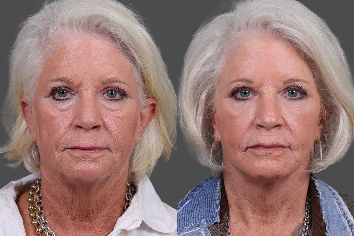 Eyelid Surgery (Blepharoplasty) Before & After Gallery - Patient 510617 - Image 1