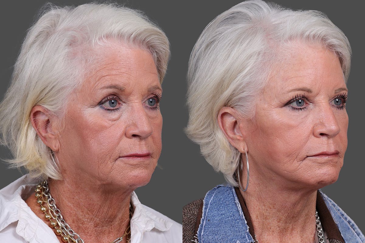 Eyelid Surgery (Blepharoplasty) Before & After Gallery - Patient 510617 - Image 2