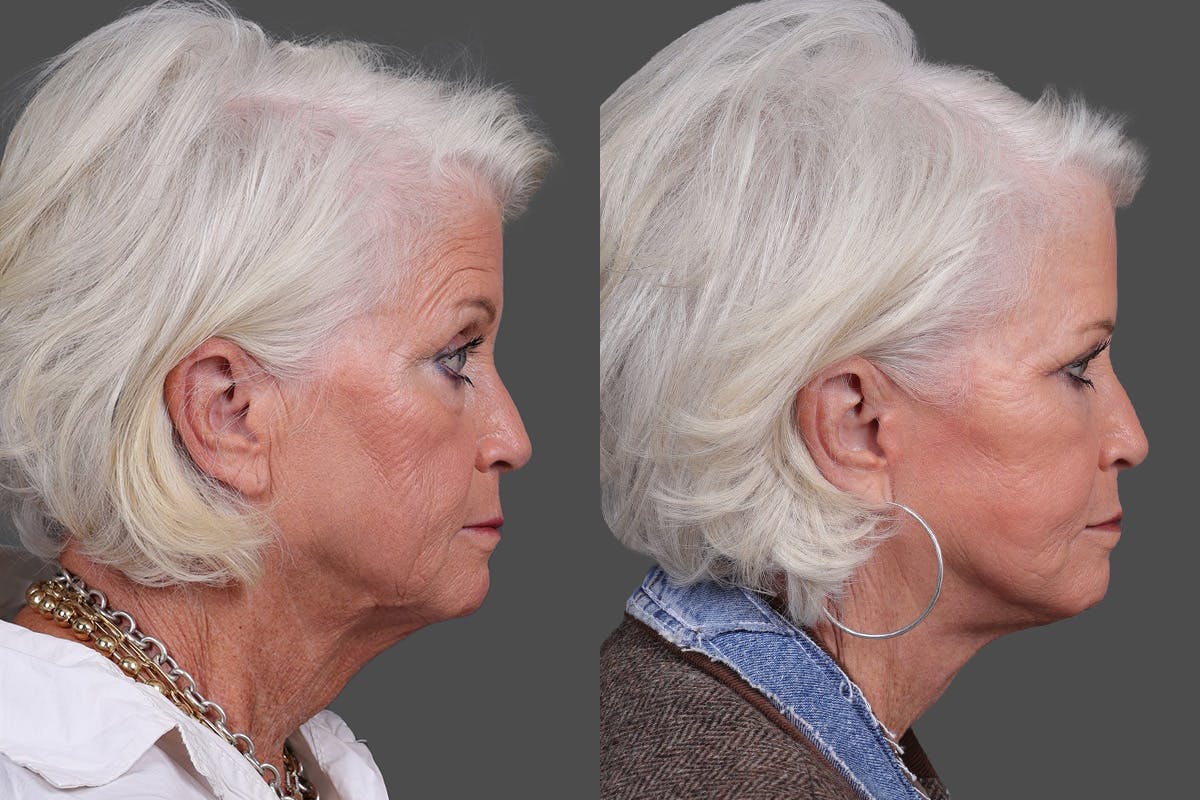 Eyelid Surgery (Blepharoplasty) Before & After Gallery - Patient 510617 - Image 3