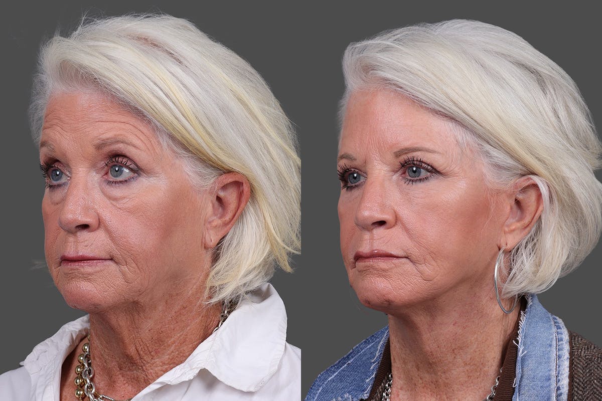 Eyelid Surgery (Blepharoplasty) Before & After Gallery - Patient 510617 - Image 4