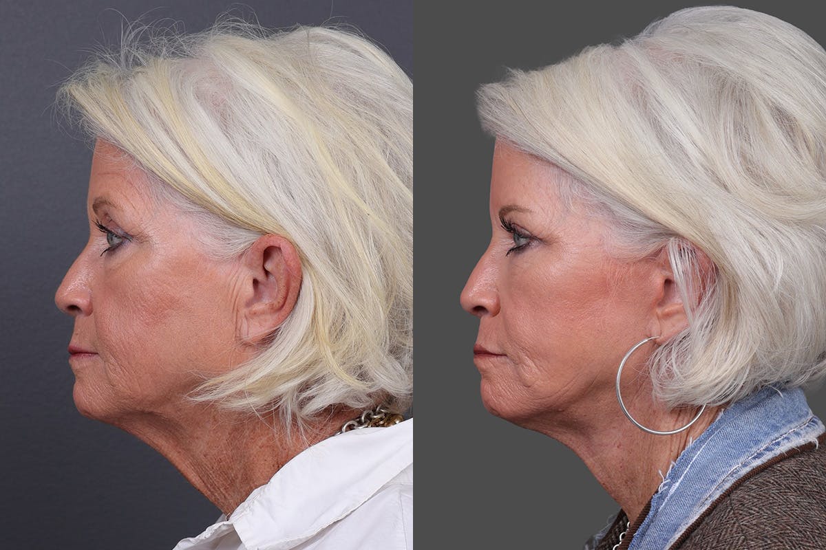 Eyelid Surgery (Blepharoplasty) Before & After Gallery - Patient 510617 - Image 5