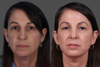 Limited Incision Facelift Before & After Gallery - Patient 379897 - Image 1