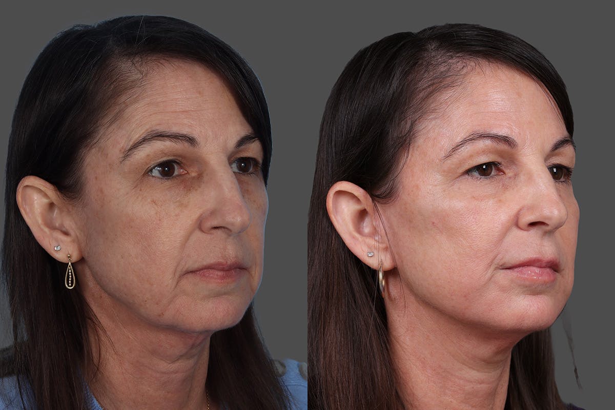Limited Incision Facelift Before & After Gallery - Patient 379897 - Image 2
