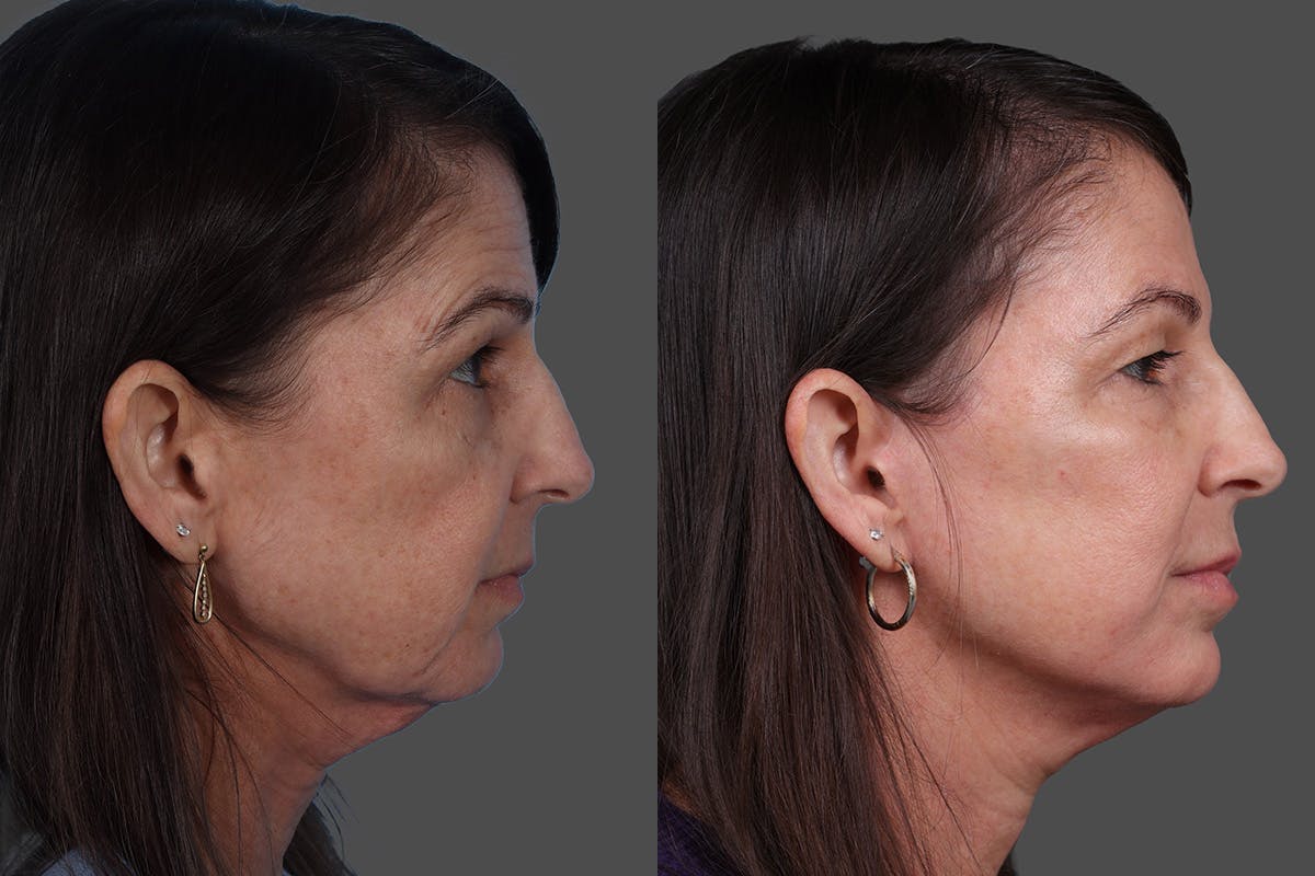 Limited Incision Facelift Before & After Gallery - Patient 379897 - Image 3