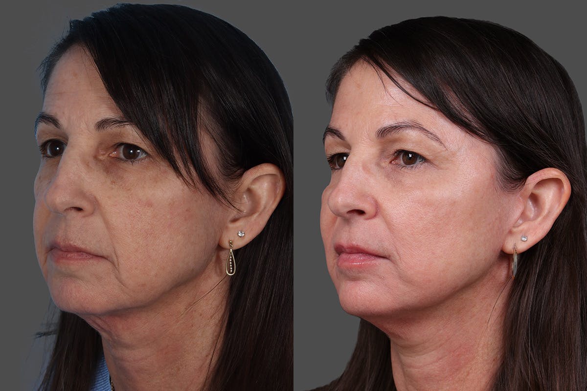 Limited Incision Facelift Before & After Gallery - Patient 379897 - Image 4