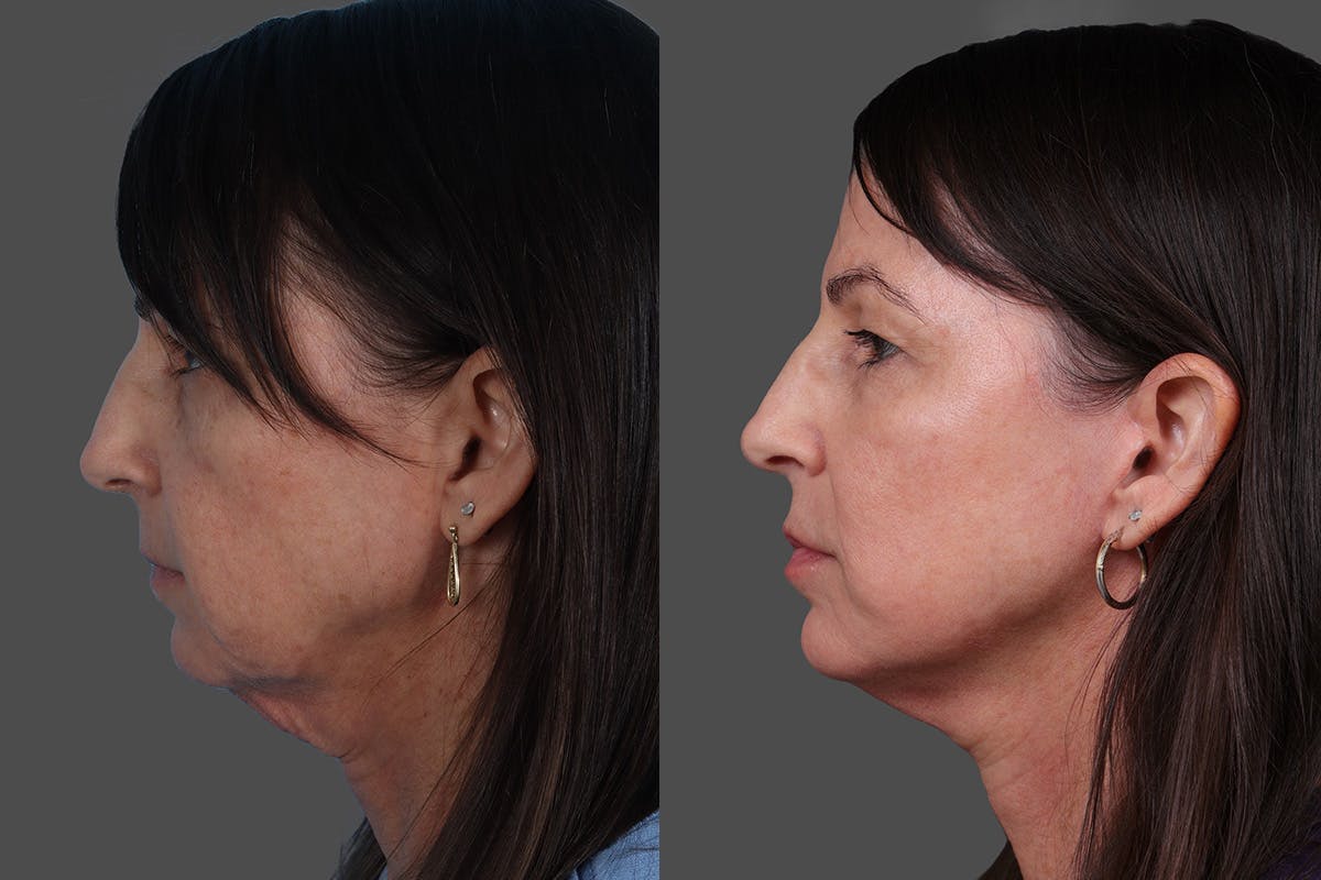 Limited Incision Facelift Before & After Gallery - Patient 379897 - Image 5