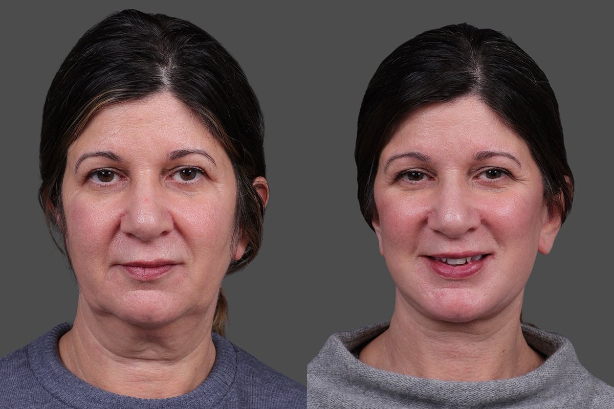 Facelift Before & After Gallery - Patient 143778 - Image 1