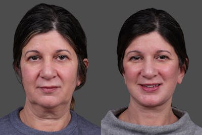 Facelift Before & After Gallery - Patient 143778 - Image 1