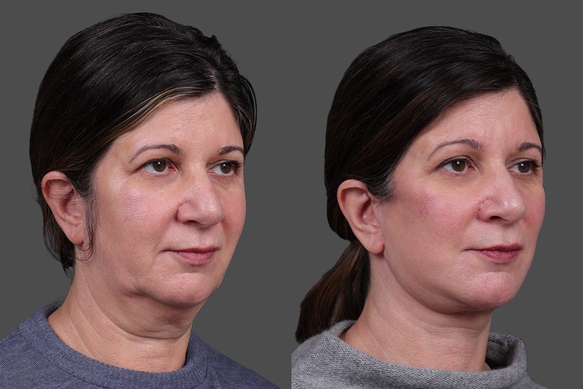 Facelift Before & After Gallery - Patient 143778 - Image 2