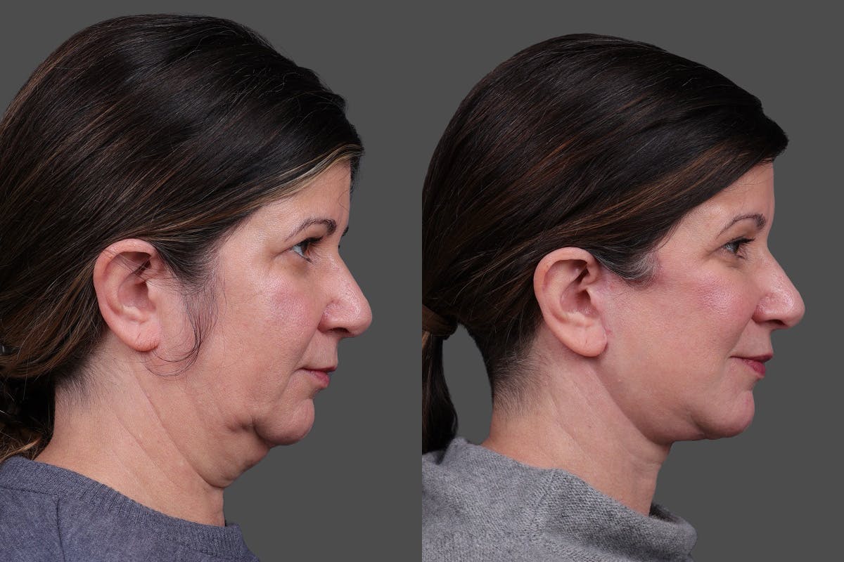 Facelift Before & After Gallery - Patient 143778 - Image 3