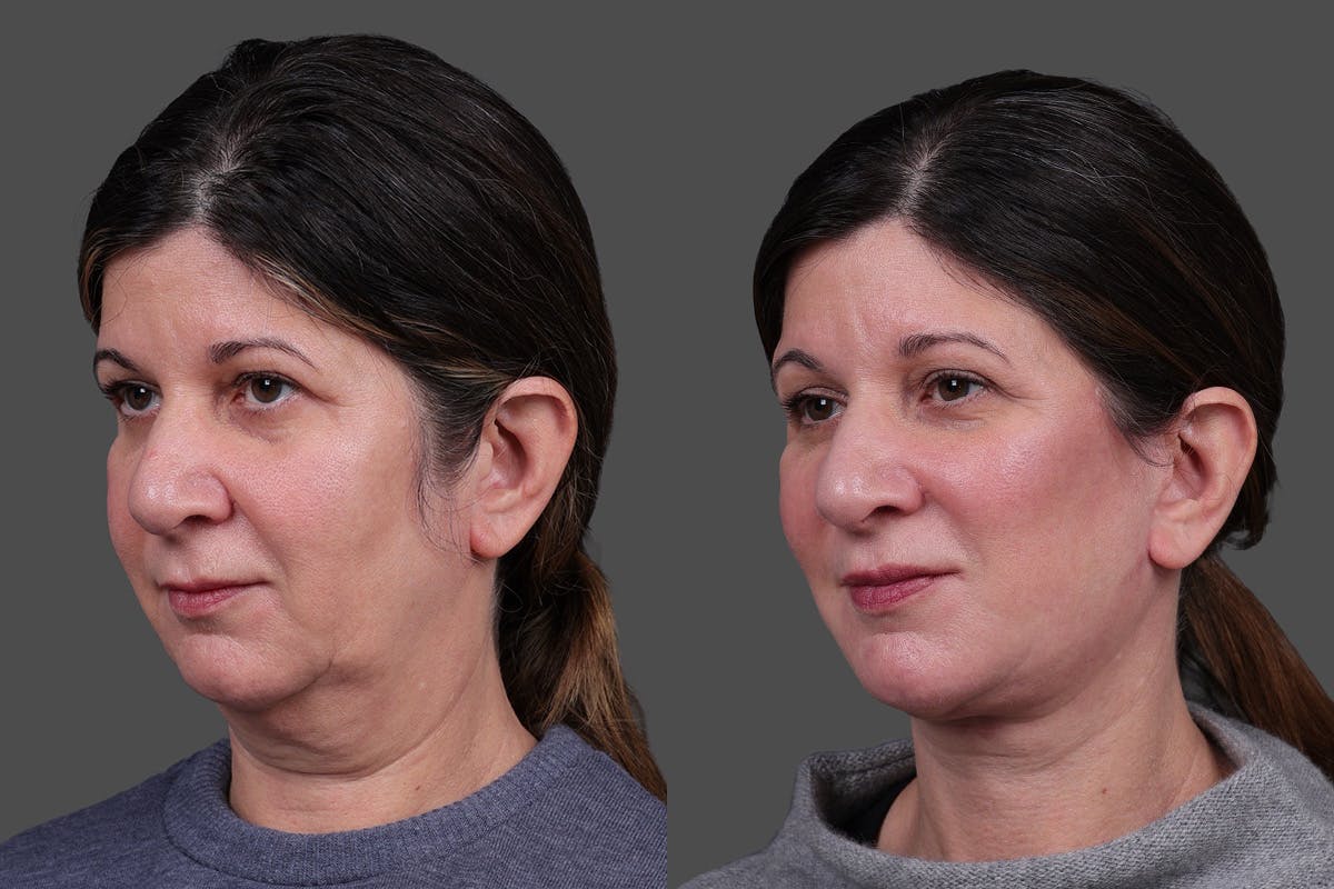 Facelift Before & After Gallery - Patient 143778 - Image 4