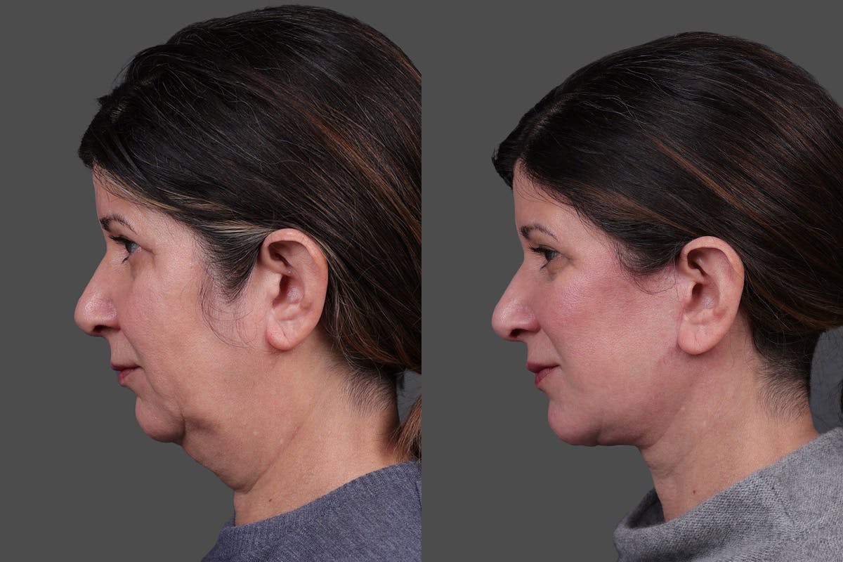 Facelift Before & After Gallery - Patient 143778 - Image 5