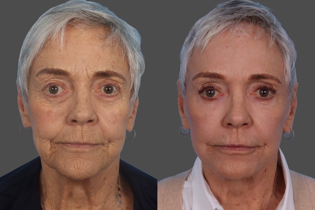 Botox Before & After Gallery - Patient 174784 - Image 1