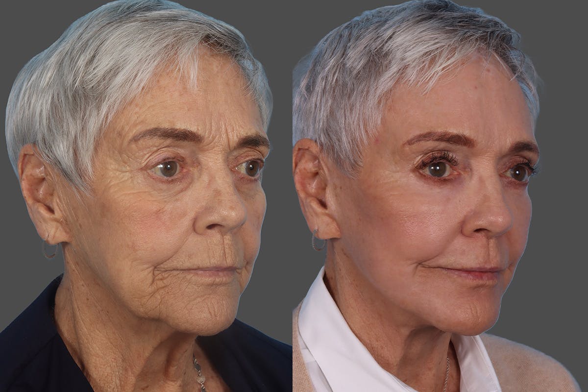 Botox Before & After Gallery - Patient 174784 - Image 2