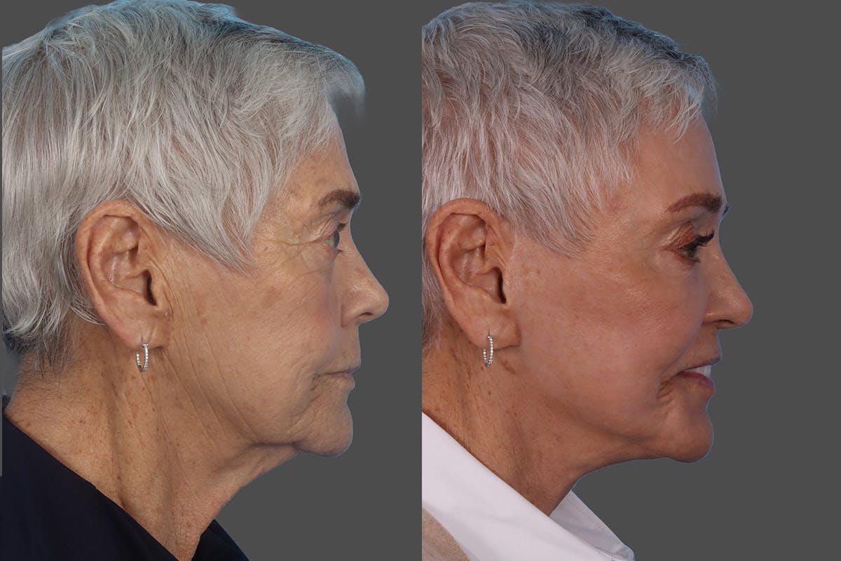 Botox Before & After Gallery - Patient 174784 - Image 3
