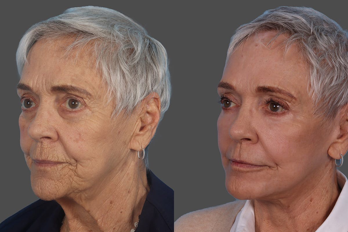 Botox Before & After Gallery - Patient 174784 - Image 4