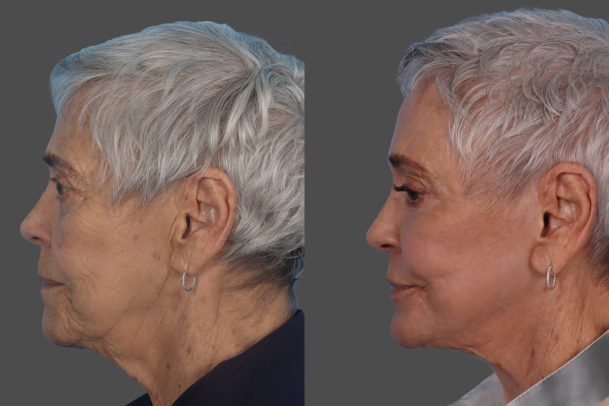 Botox Before & After Gallery - Patient 174784 - Image 5