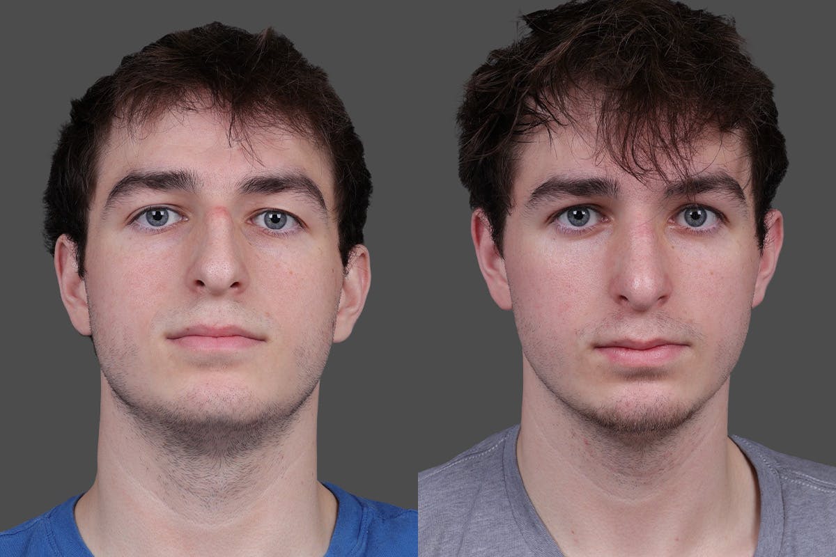 Rhinoplasty Before & After Gallery - Patient 391820 - Image 3