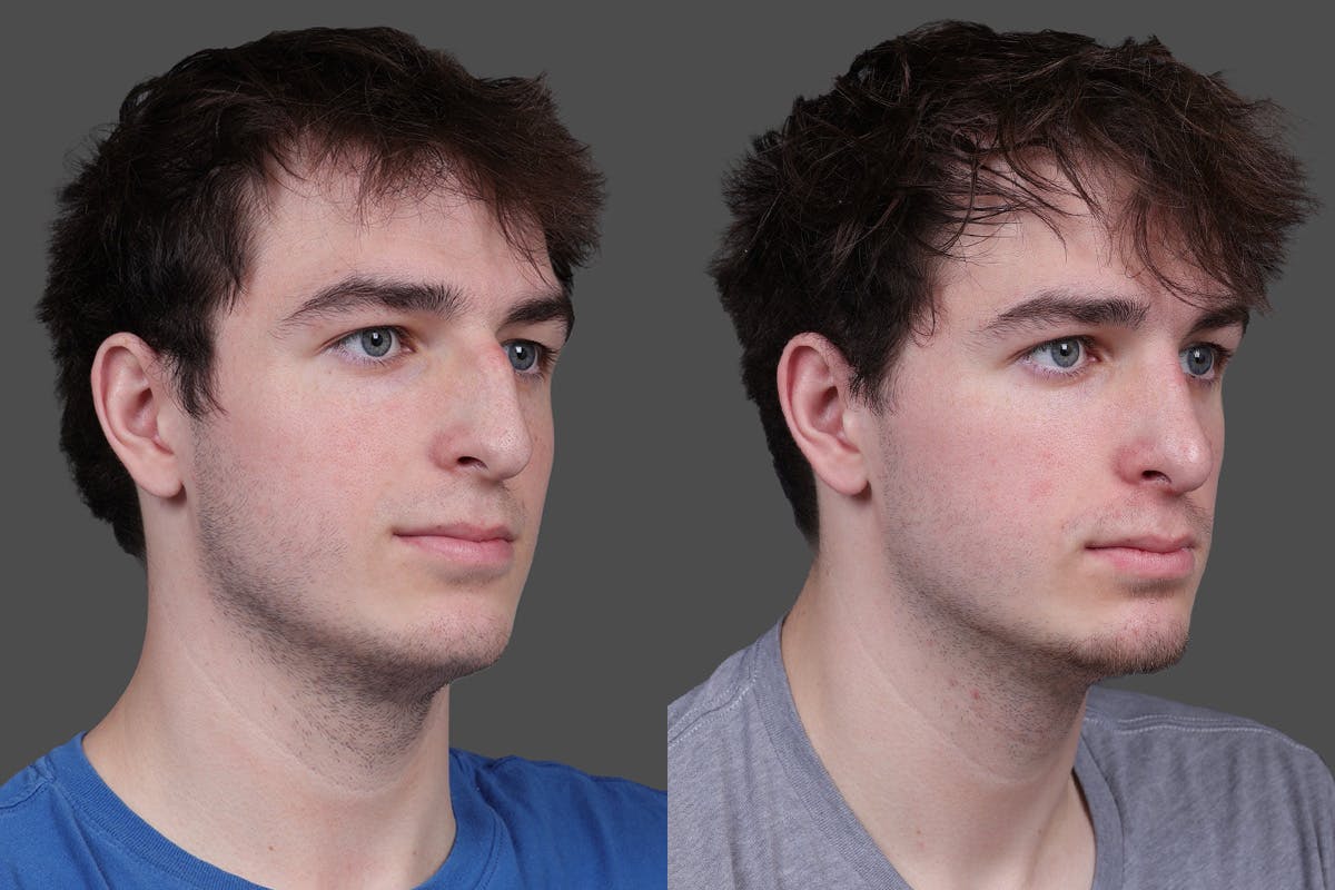 Rhinoplasty Before & After Gallery - Patient 391820 - Image 2
