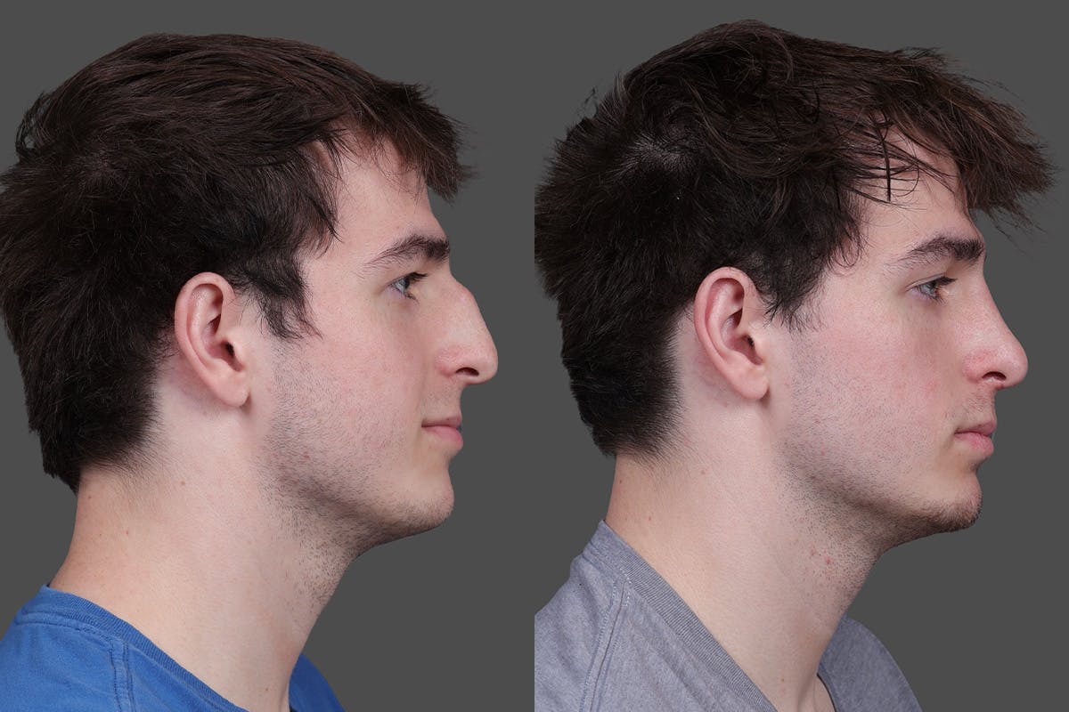Rhinoplasty Before & After Gallery - Patient 391820 - Image 1