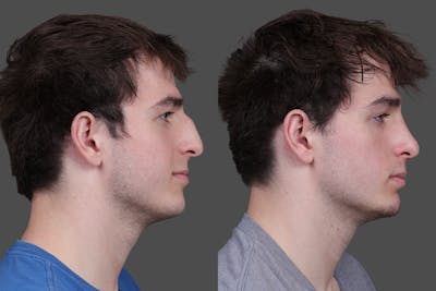 Rhinoplasty Before & After Gallery - Patient 391820 - Image 1