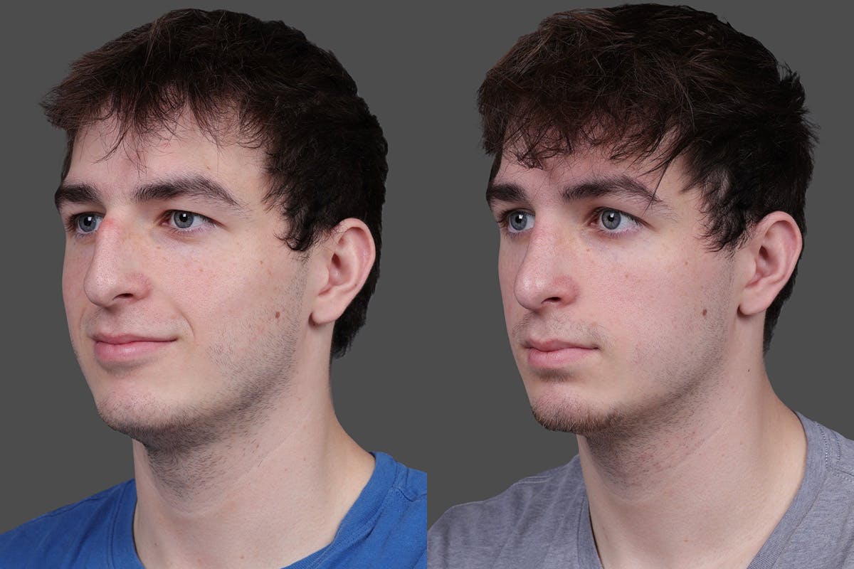 Rhinoplasty Before & After Gallery - Patient 391820 - Image 4