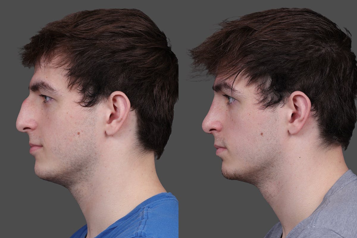 Rhinoplasty Before & After Gallery - Patient 391820 - Image 5