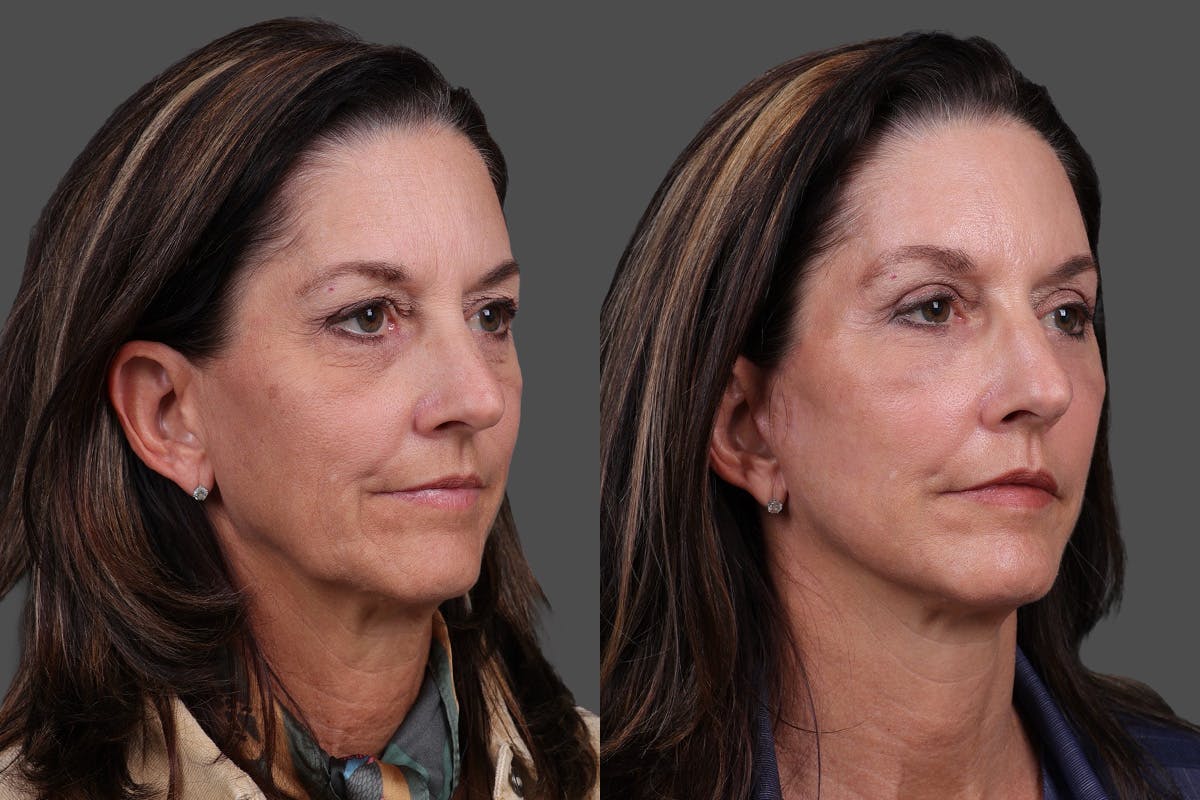 Facelift Before & After Gallery - Patient 195067 - Image 2