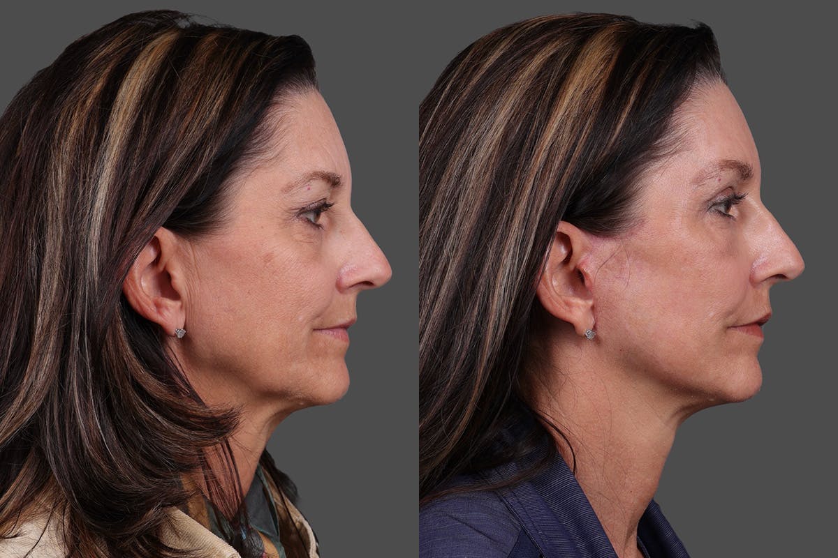 Facelift Before & After Gallery - Patient 195067 - Image 3
