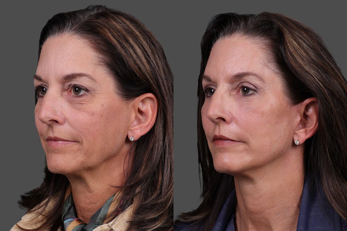 Facelift Before & After Gallery - Patient 195067 - Image 4
