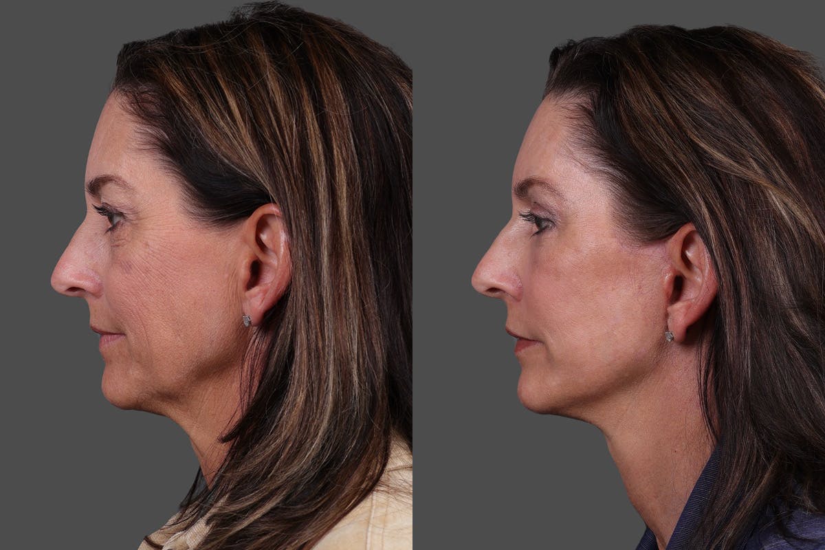 Facelift Before & After Gallery - Patient 195067 - Image 5