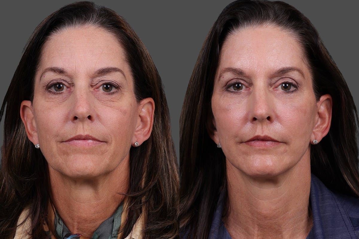 Facelift Before & After Gallery - Patient 195067 - Image 1