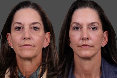 Facelift Before & After Gallery - Patient 195067 - Image 1