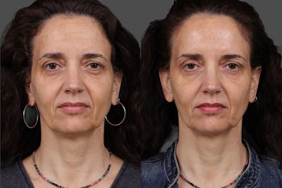Botox Before & After Gallery - Patient 413415 - Image 1