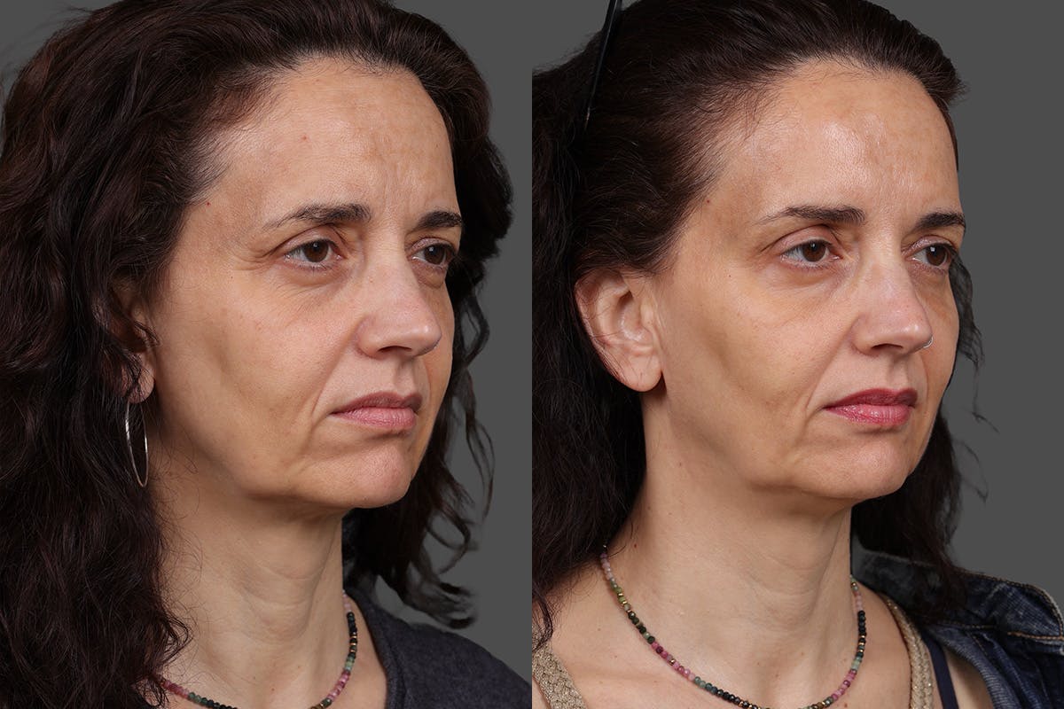 Botox Before & After Gallery - Patient 413415 - Image 2
