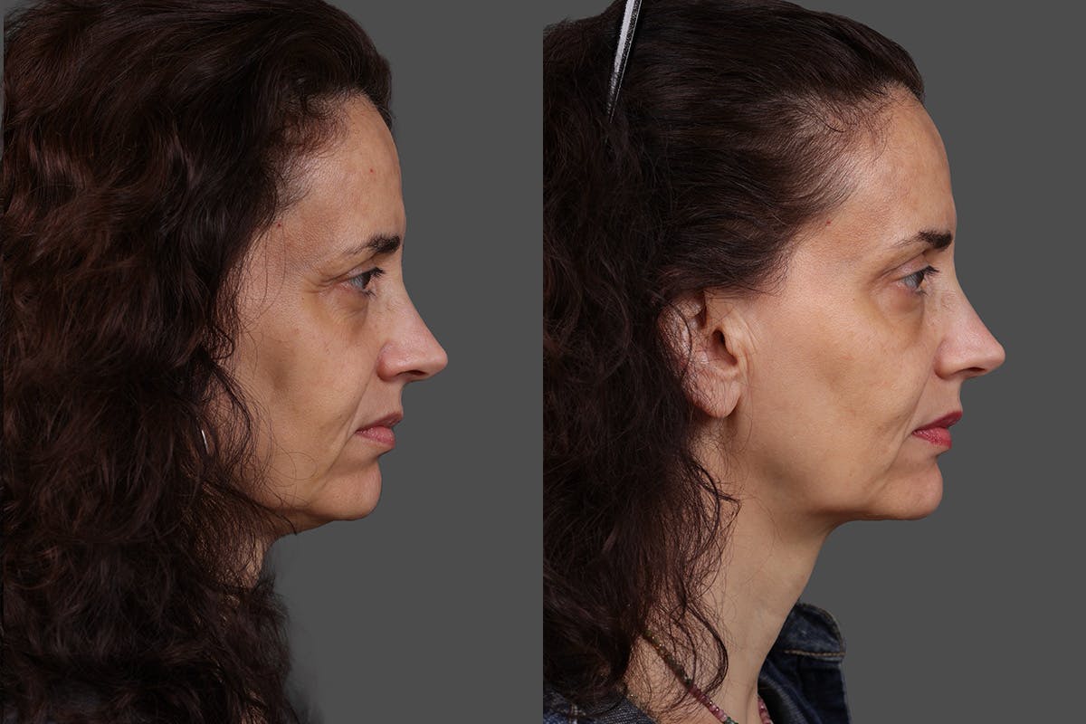 Botox Before & After Gallery - Patient 413415 - Image 3