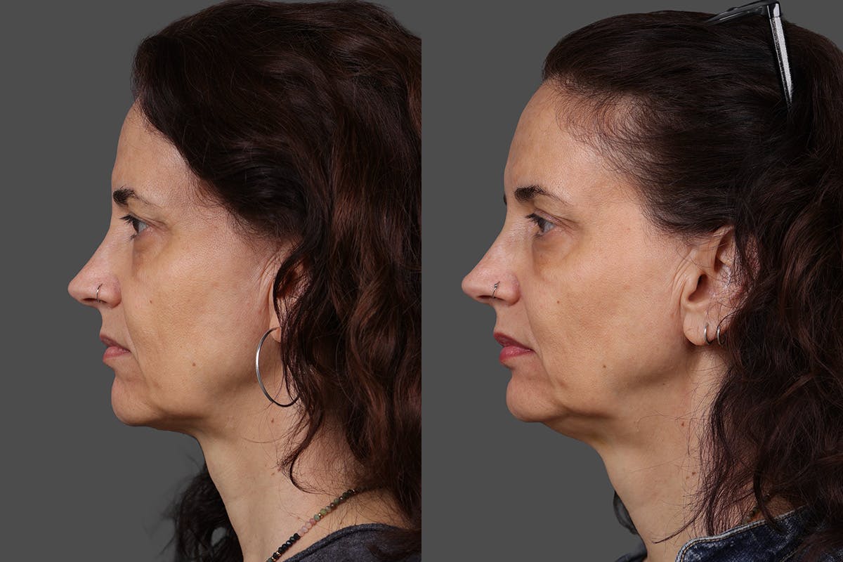 Botox Before & After Gallery - Patient 413415 - Image 5