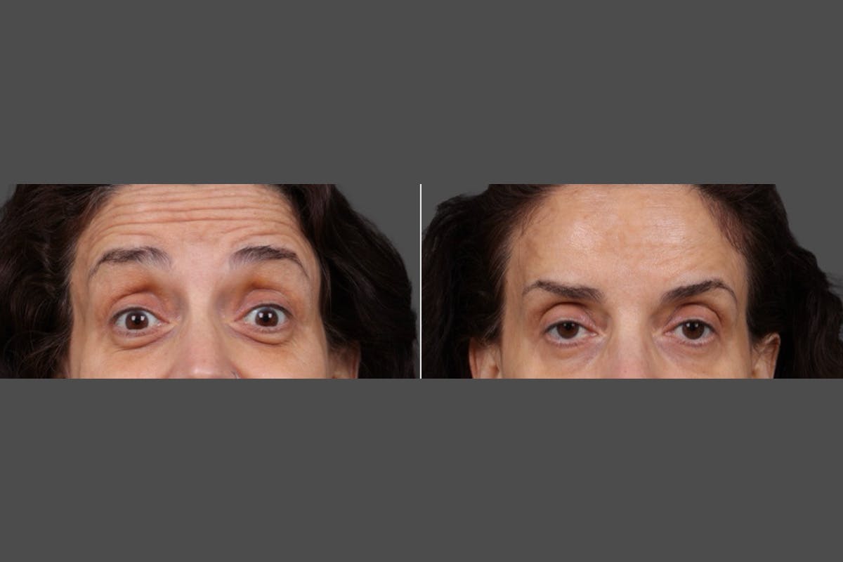 Botox Before & After Gallery - Patient 413415 - Image 7