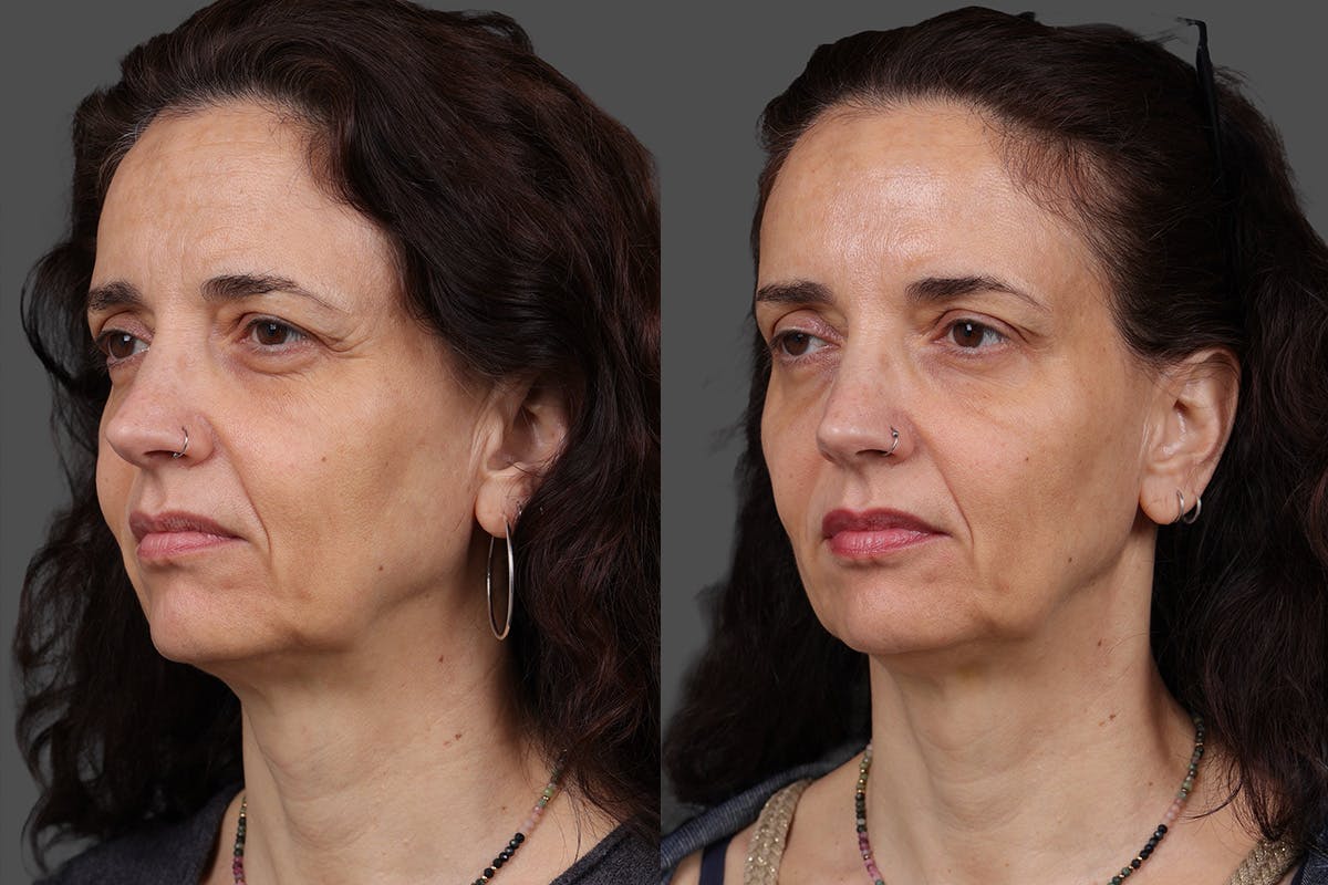 Botox Before & After Gallery - Patient 413415 - Image 4
