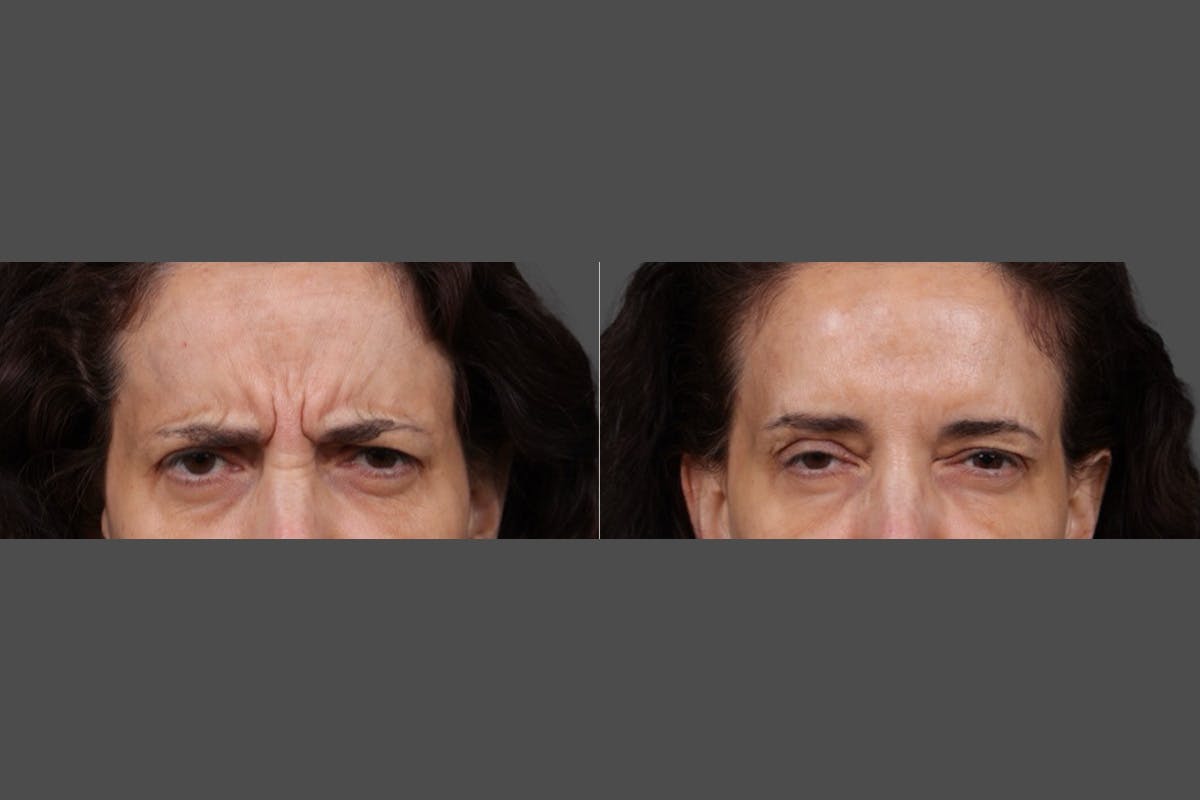 Botox Before & After Gallery - Patient 413415 - Image 6