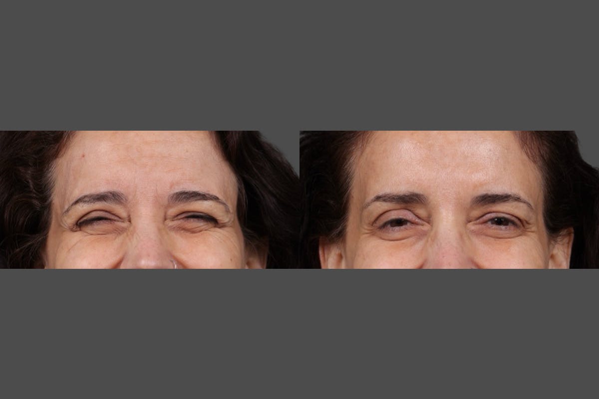 Botox Before & After Gallery - Patient 413415 - Image 8