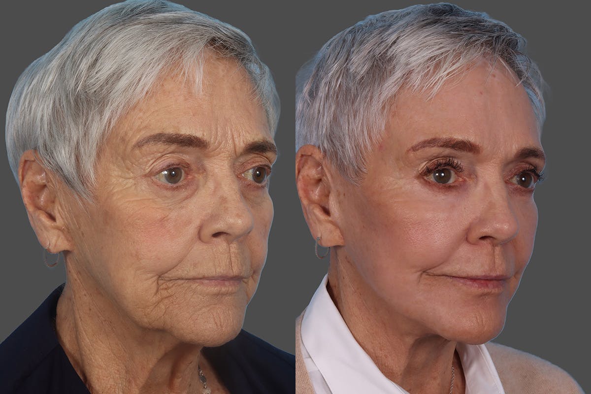 Facial Fat Transfer Before & After Gallery - Patient 268653 - Image 2