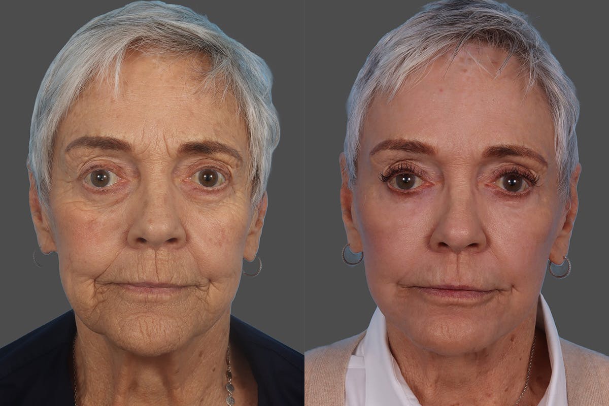 Facial Fat Transfer Before & After Gallery - Patient 268653 - Image 1