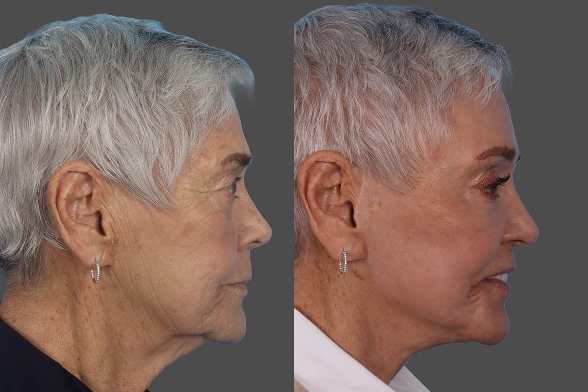Facial Fat Transfer Before & After Gallery - Patient 268653 - Image 3