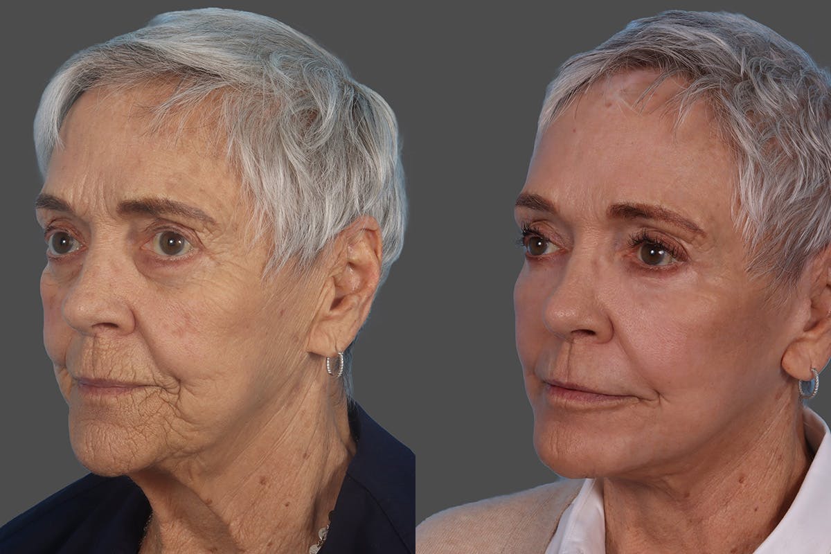 Facial Fat Transfer Before & After Gallery - Patient 268653 - Image 4